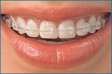 clearBraces_guelphortho